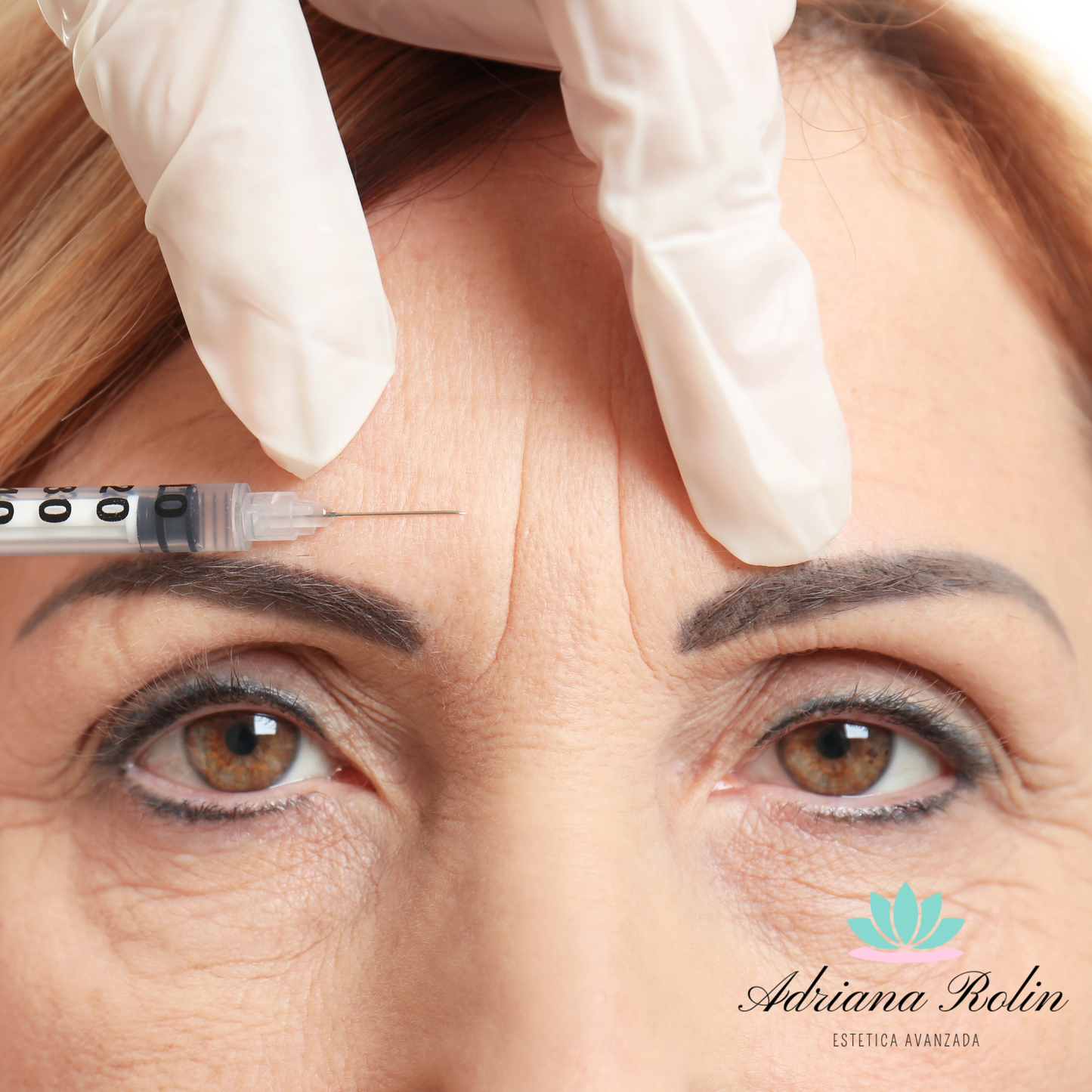 Aplicación de Bótox