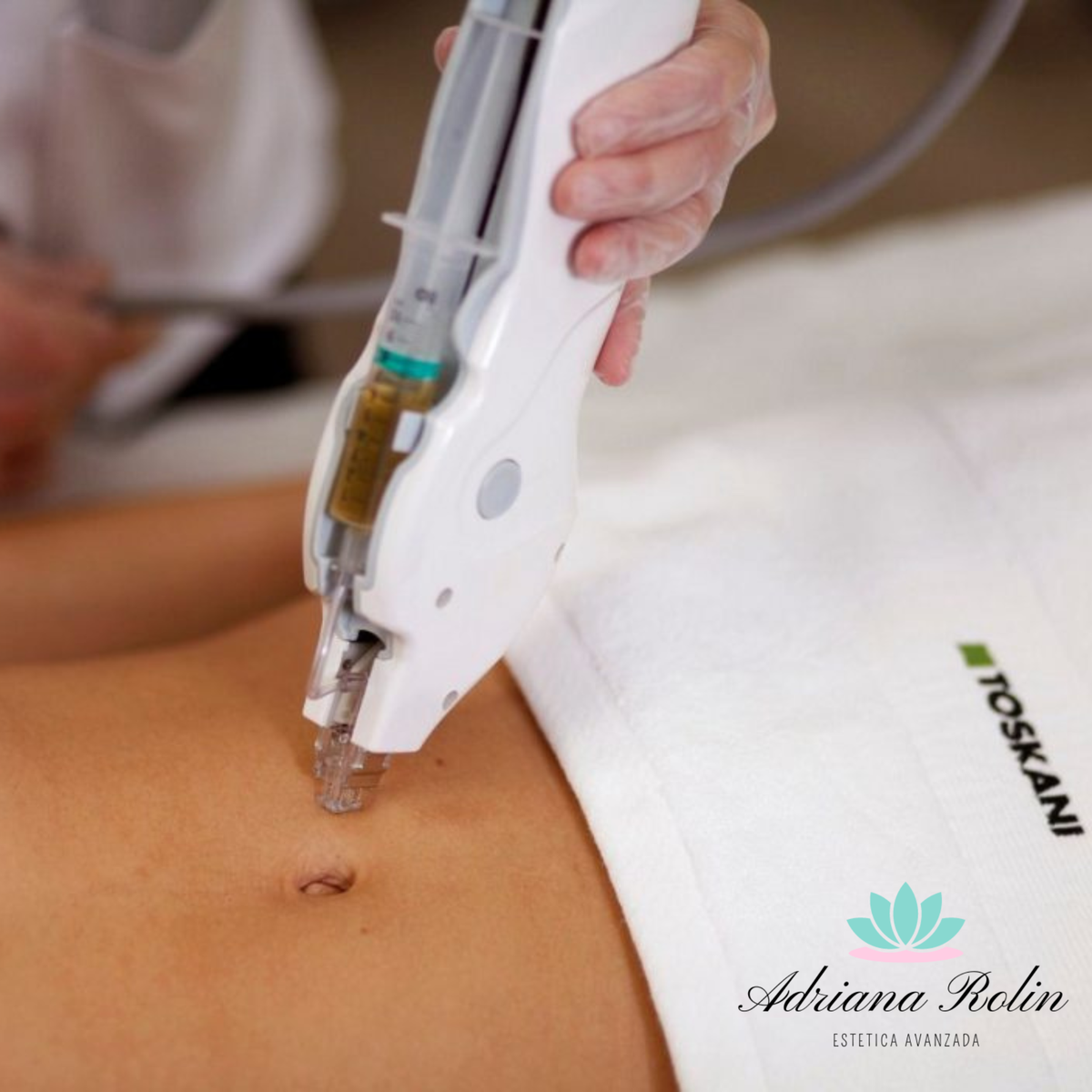 Mesoterapia Corporal 6 Sesiones - Adriana Rolin Estética Avanzada